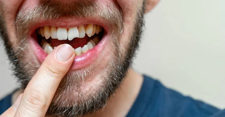 Chipped Tooth Crown