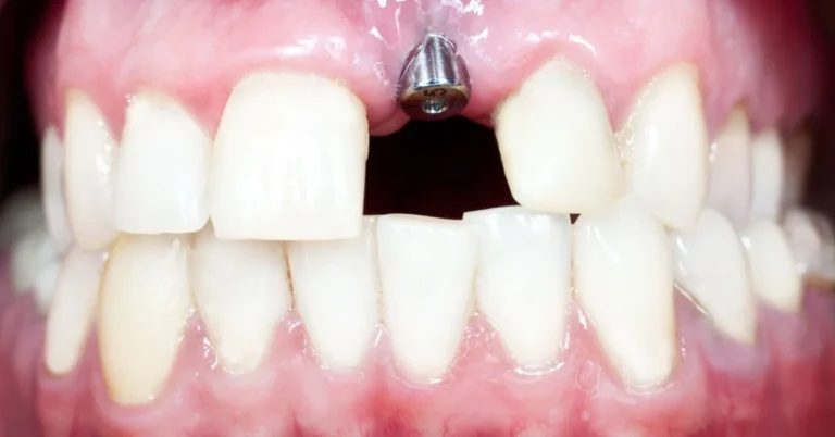 Dental Implants