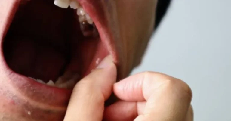 Roof of Your Mouth