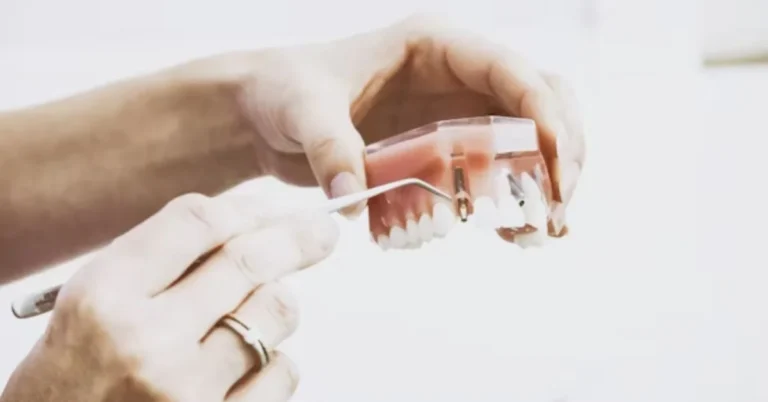 Dental Veneers
